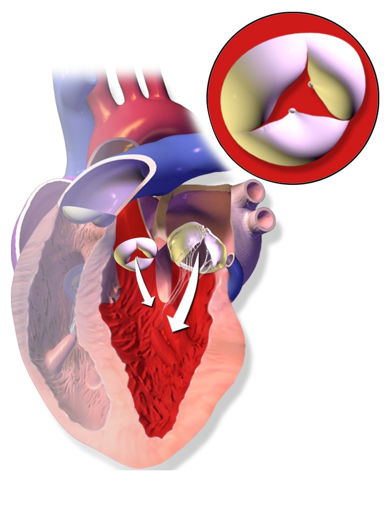 Cabinet de Cardiologie et d'explorations cardio-vasculaires - Dr. Nadia  Srairi - Maladies de la valve aortique
